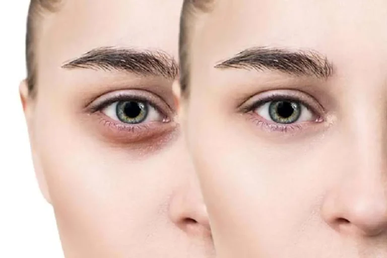 کربوکسی‌تراپی چیست؟ درمان تیرگی زیر چشم، سلولیت و چربی موضعی با تزریق CO₂